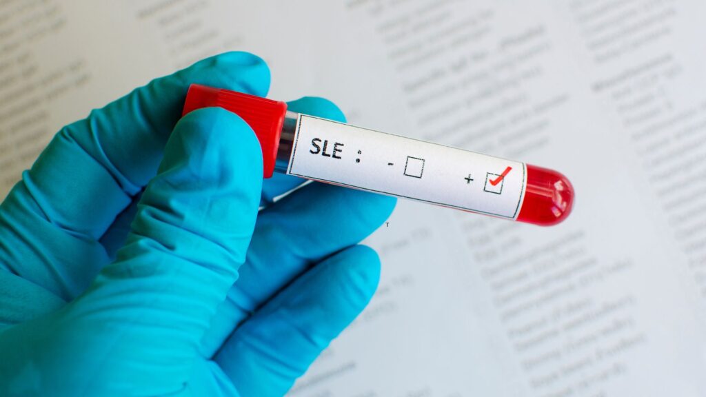 What causes lupus
