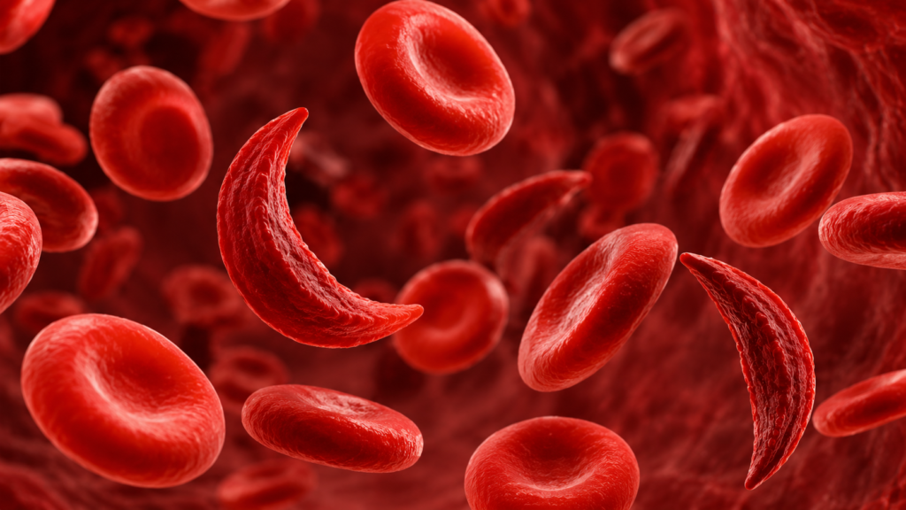 sickle cell anaemia