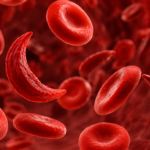 sickle cell anaemia